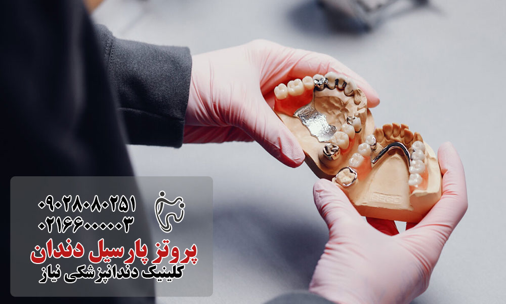 مزایای پروتز پارسیل