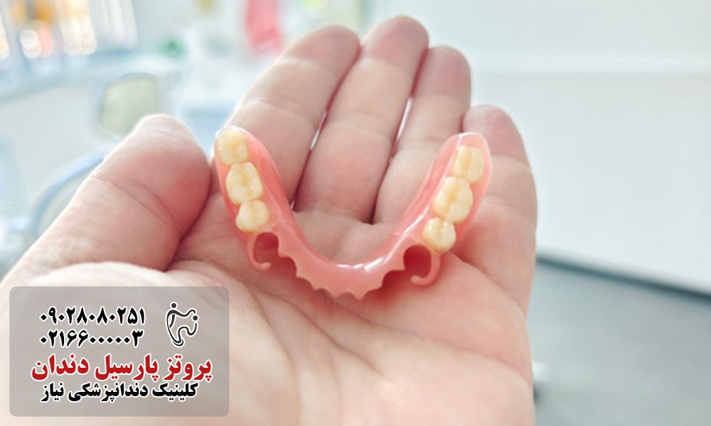 مقایسه پروتز پارسیل با ایمپلنت و بریج