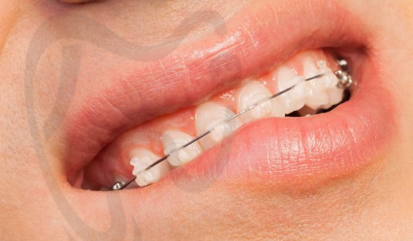 کاهش درد و التهاب بعد از تنظیم براکت