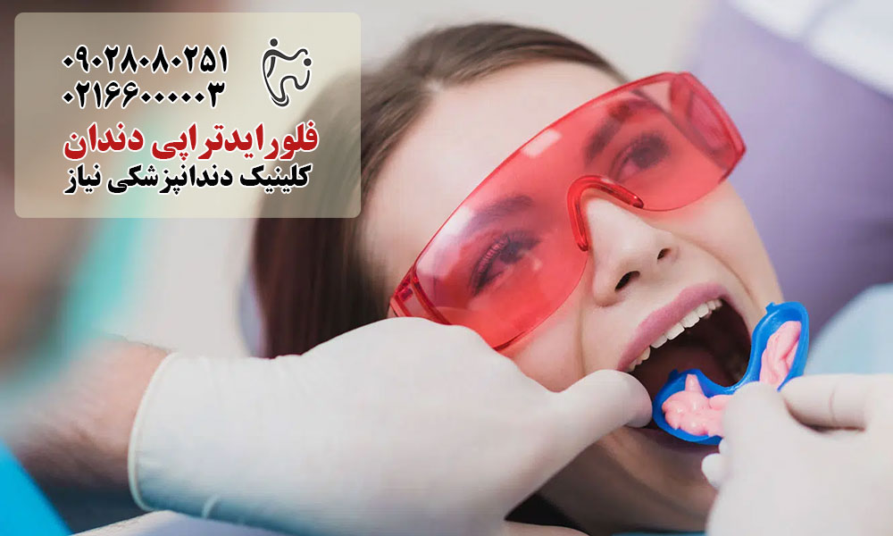 انواع فلورایدتراپی دندان