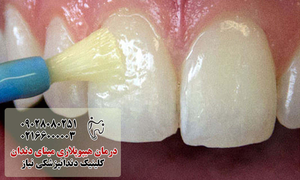 درمان هیپوپلازی مینای دندان