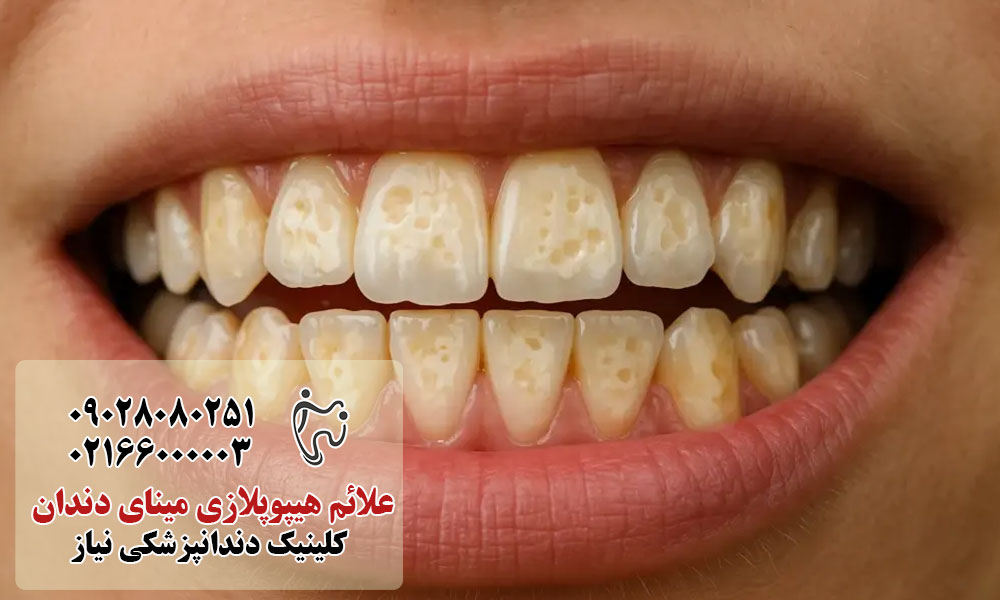 علائم هیپوپلازی مینای دندان