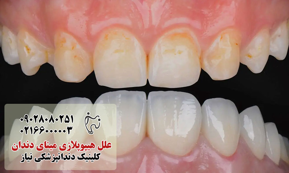 علل هیپوپلازی مینای دندان