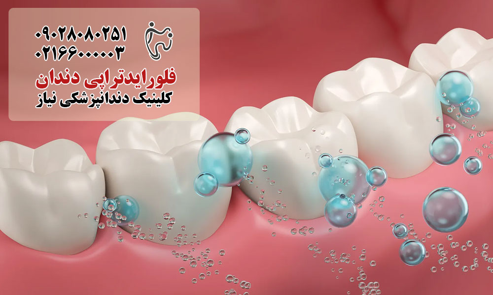 فلوراید تراپی در تهران