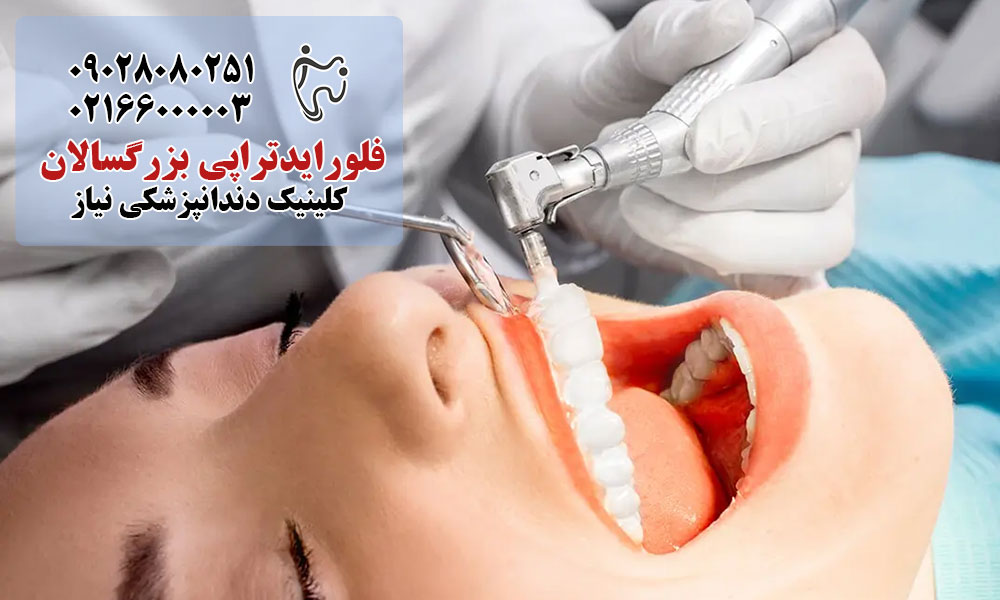 فلورایدتراپی بزرگسالان