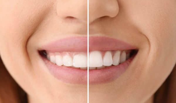 مراقبت های پس از کانتورینگ لثه