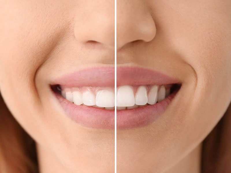 مراقبت های پس از کانتورینگ لثه