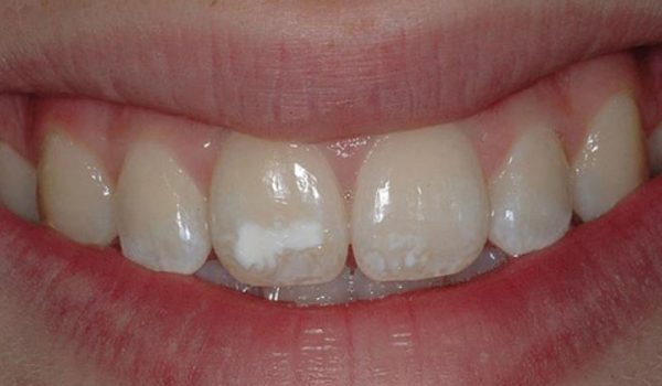 هیپوپلازی مینای دندان چیست