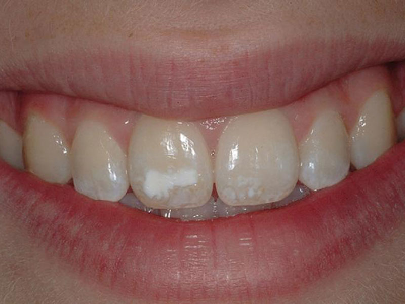 هیپوپلازی مینای دندان چیست