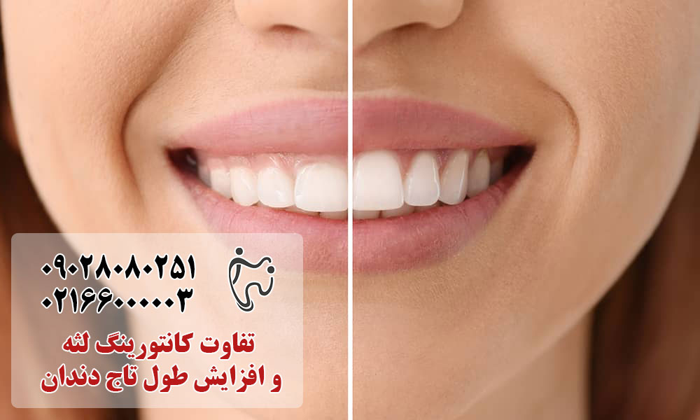 تفاوت کانتورینگ لثه و افزایش طول تاج دندان