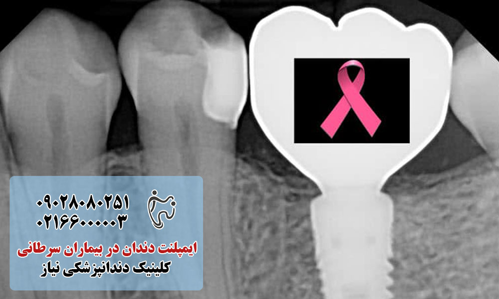 تاثیر درمان سرطان بر سلامت دندان