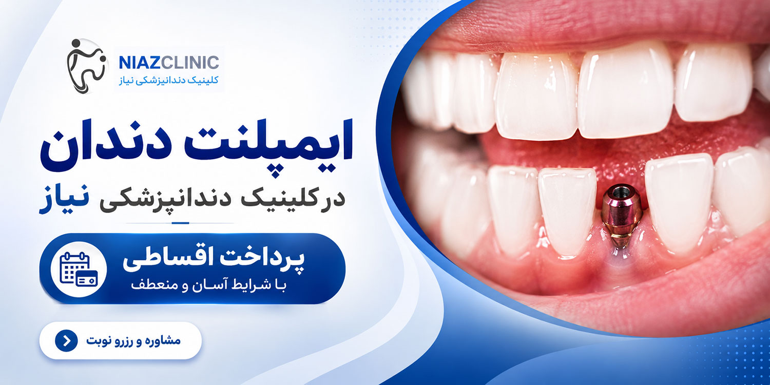 ایمپلنت دندان در کلینیک دندانپزشکی نیاز
